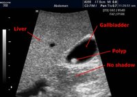 Gallbladder_Polyp_Ultrasound.jpg
