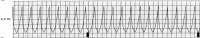 ekg11.jpg