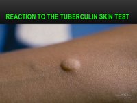 tuberculin-testing-13-728.jpg