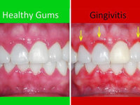 gum-disease-1200x900.jpg