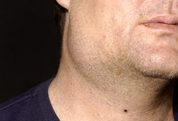 493ss_photo_researchers_rm_photo_of_adult_mumps.jpg