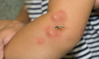 how-to-know-if-it-is-a-wasp-sting.jpg