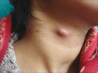 A-subcutaneous-swelling-on-right-middle-of-neck.jpg