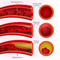 HYPERTENSION.jpg