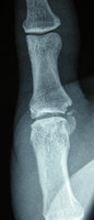 ligament-small-bone-injury.jpg