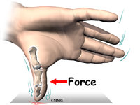 ulnar_collateral_thumb_causes01.jpg