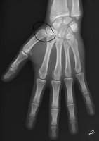 X-ray_of_normal_hand_by_dorsoplantar_projection.jpg