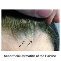 Sebderm-hairline.jpg