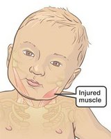 torticollis-www.aboutkidshealth-ca.jpg