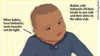 torticollisCongenital_a_enIL.jpg