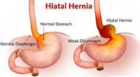 hiatal-herniah.jpg