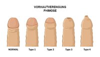 phimose-vorhaut-beschneidung.jpg