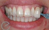 before-enlighten-teeth-whitening-treatment-image.jpg