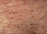 Fig._2._Pubic_lice_in_abdomen.jpg