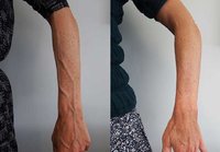 arm-veins-left-1-e1632445133905.jpg