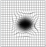 Central-serous-chorioretinopathy-2.b8325ee.jpg