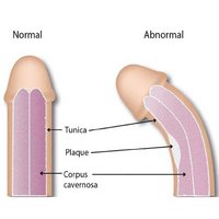 penis-curvature-when-to-see-a-doctor.jpg