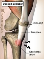 knie-osgood-schlatter-pijn-patella-pees.jpg