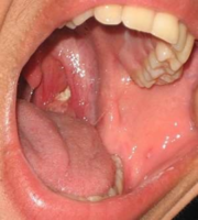 Tonsils-Stones-270x300.png