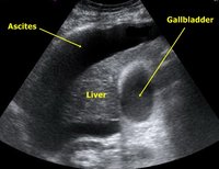 Ascites_Liver_Ultrasound.jpg