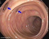 diverticulosis3.jpg