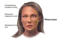 myasthenia-gravis-forms-symptoms-and-treatment-1.jpg