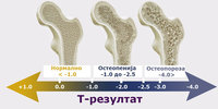 osteoporoza-osteopenija-t-rezultat.jpg