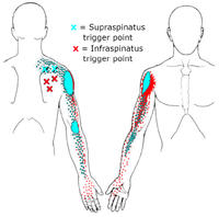 Supraspinatus-and-infraspinatus-trigger-points.png