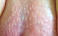 fordyce-spots-on-vulva-image-credit-dermatech99-2010-january-1.png