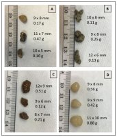 Image-of-each-stone-used-in-the-study-A-calcium-oxalate-monohydrate-B-ammonium-acid.jpg