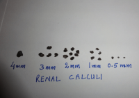 Different-size-of-renal-calculi-passed-out-along-with-urine-after-the-herbal-treatment.png