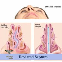 deviated-septum.jpg