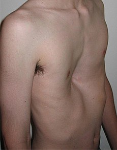 230px-Pectus1.jpg
