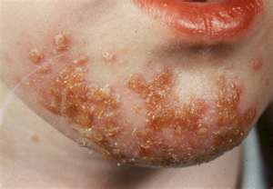 Impetigo+2.jpg