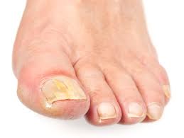 toenail-fungus.jpeg