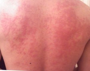 Hives_on_back.jpg