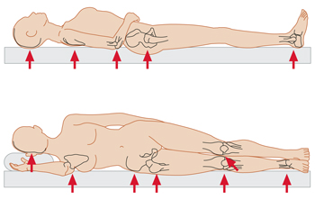 afbeelding-oorzaak-decubitus.jpg