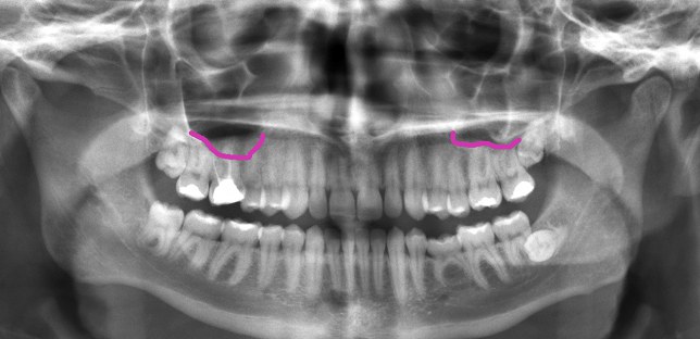 sinuses_on_dental_xray.jpg