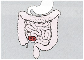 operatietechniekenileostoma3.jpg