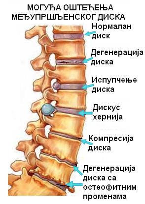 Naj%C4%8De%C5%A1%C4%87e_degenerativne_promene_IV_diska..JPG